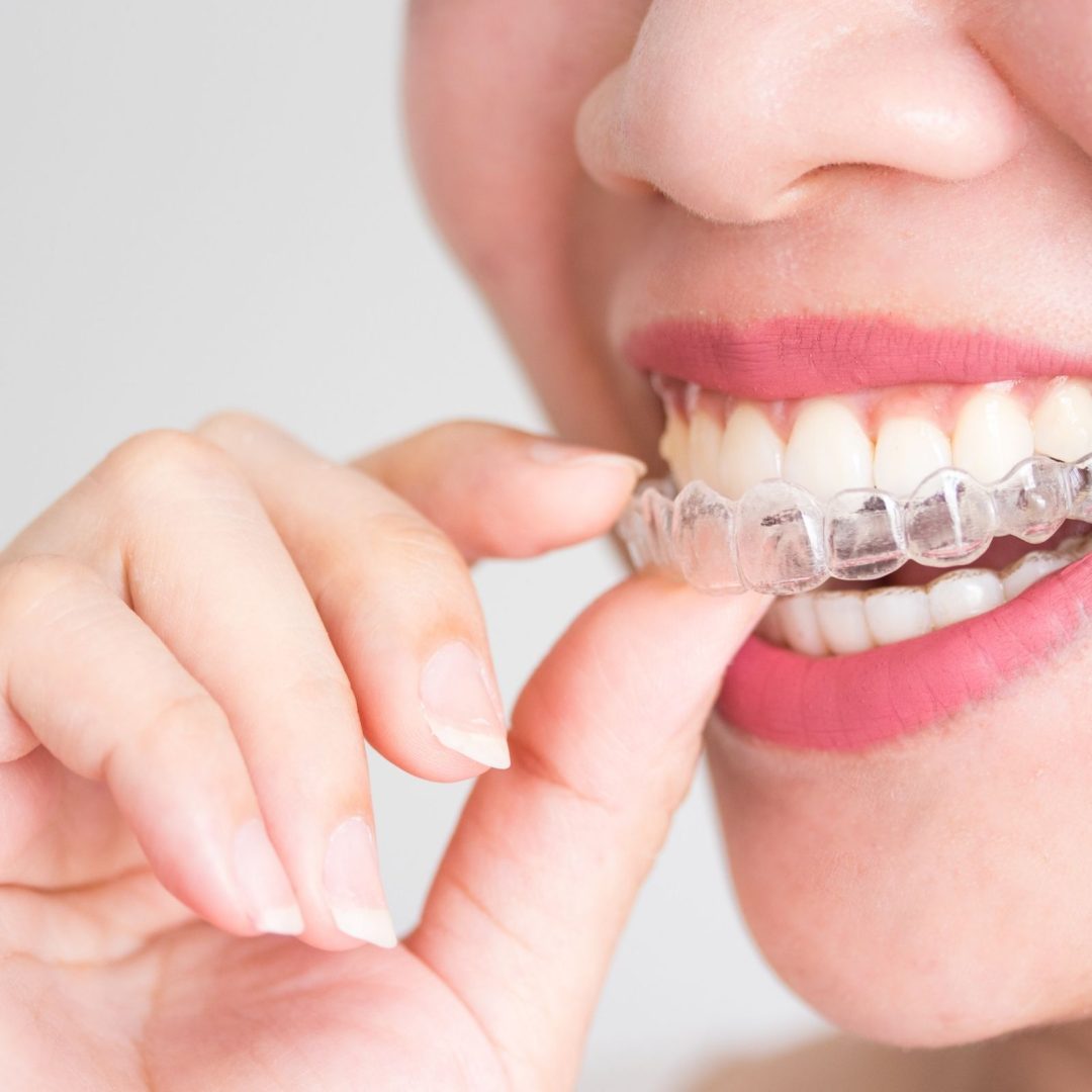 Invisalign-Vs-Braces